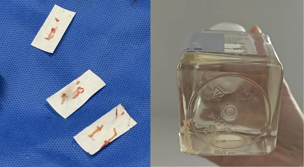 Tumor tissue samples and biopsy specimens for TILs cell therapy preparation