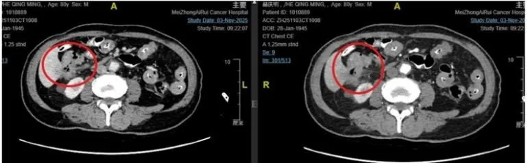 CT scan showing ascending colon tumor with liver invasion — circled in red