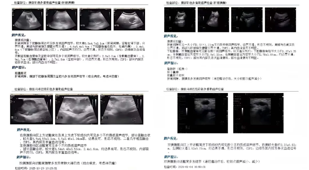 Ultrasound comparison scans before and after bispecific antibody treatment, showing marked reduction in abdominal, pelvic, and inguinal lymph node sizes.