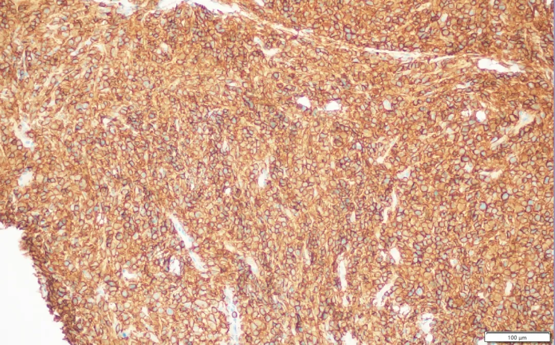 Bcl-2 immunohistochemistry showing strong diffuse positivity in PMBCL tumor cells indicating anti-apoptotic protein overexpression