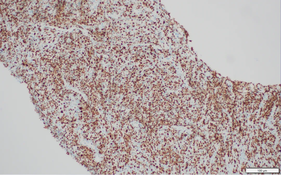 CD20 immunohistochemistry stain showing strong membranous positivity in PMBCL tumor cells confirming B-cell lineage
