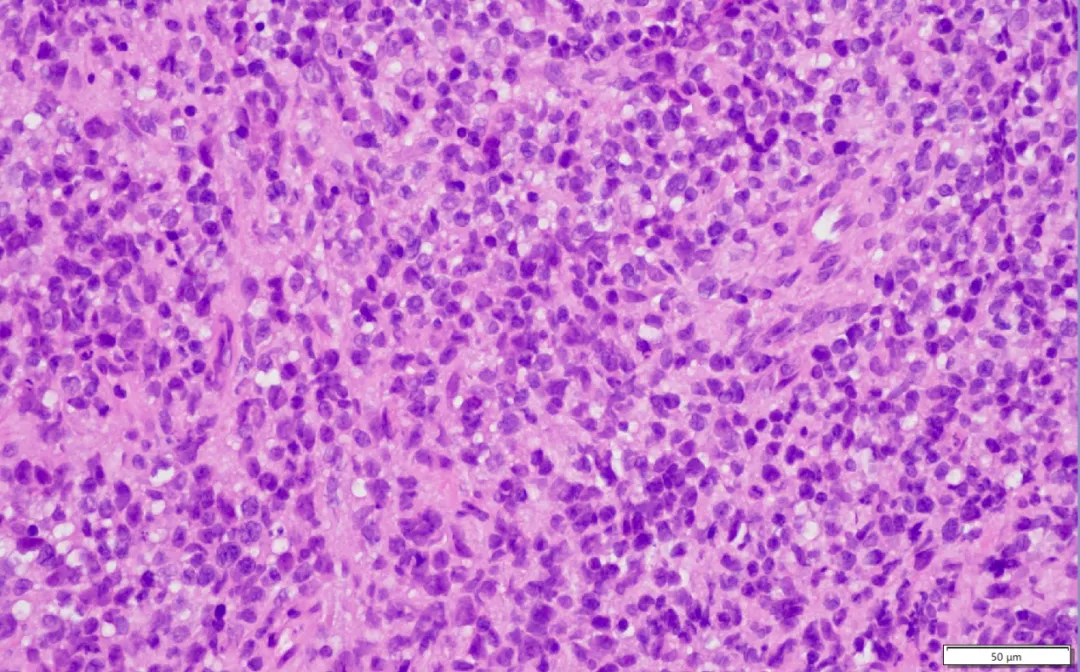 Ki67 immunohistochemistry showing very high proliferation index in PMBCL tumor cells indicating aggressive growth