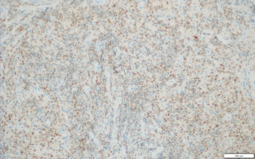 MUM1 immunohistochemistry stain showing nuclear positivity in PMBCL indicating non-GCB phenotype