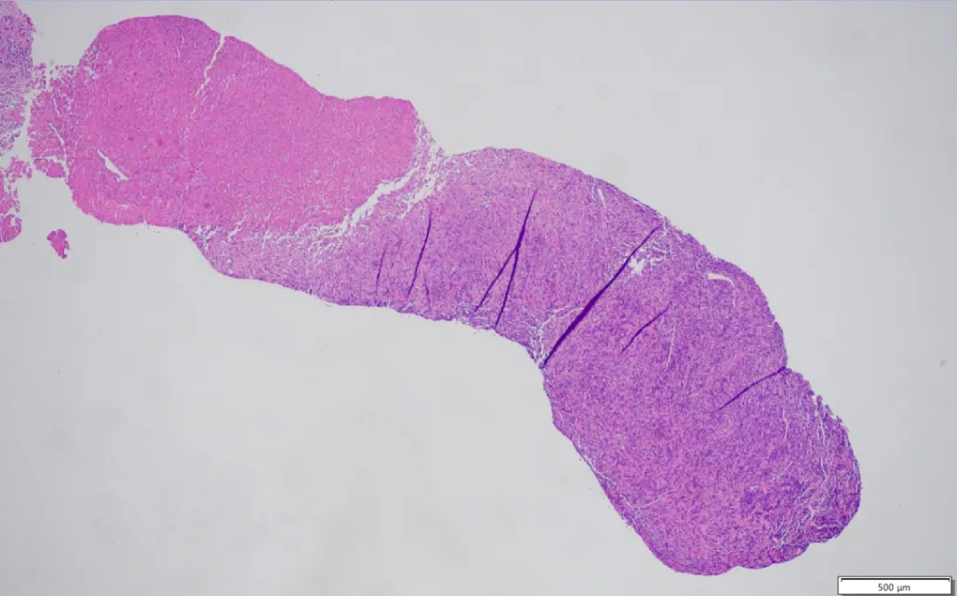 High-power histopathology of PMBCL showing medium-to-large tumor cells with round nuclei, dark staining, and scant cytoplasm