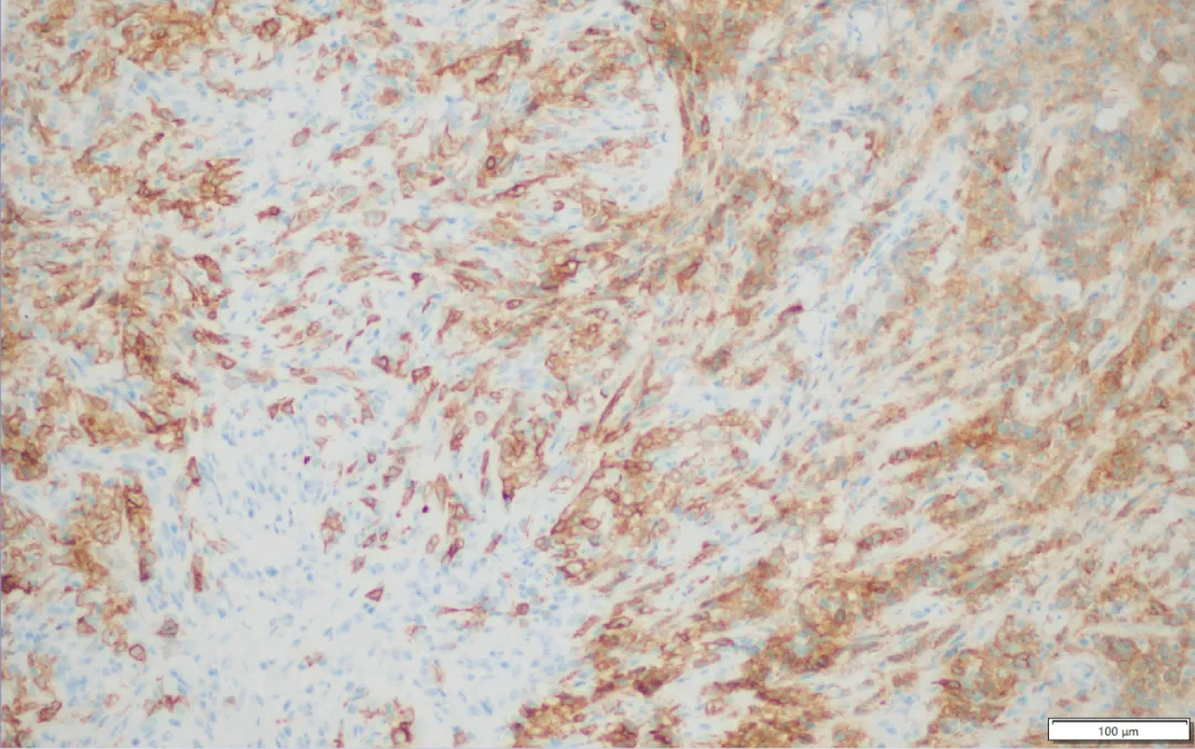 Low-power histopathology of PMBCL showing diffuse tumor cell distribution with large areas of coagulative necrosis