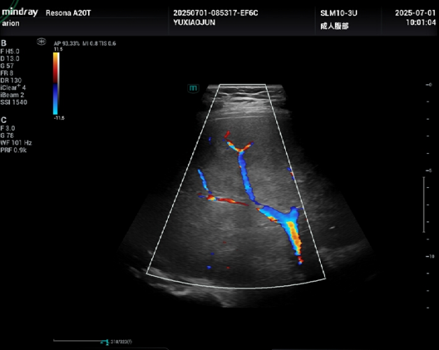 Doppler ultrasound showing reversed hepatofugal flow in the right portal vein branch