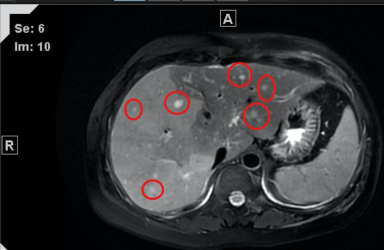 Liver MRI showing multiple scattered metastatic lesions throughout both hepatic lobes