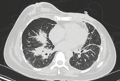 Chest CT showing right lower lobe patchy infiltrate — insufficient to explain severity of hypoxemia