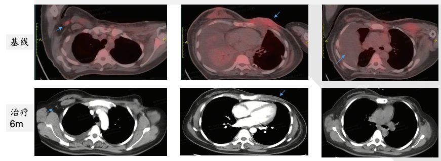 PET-CT comparison baseline versus 6 months of treatment showing dramatic metabolic response