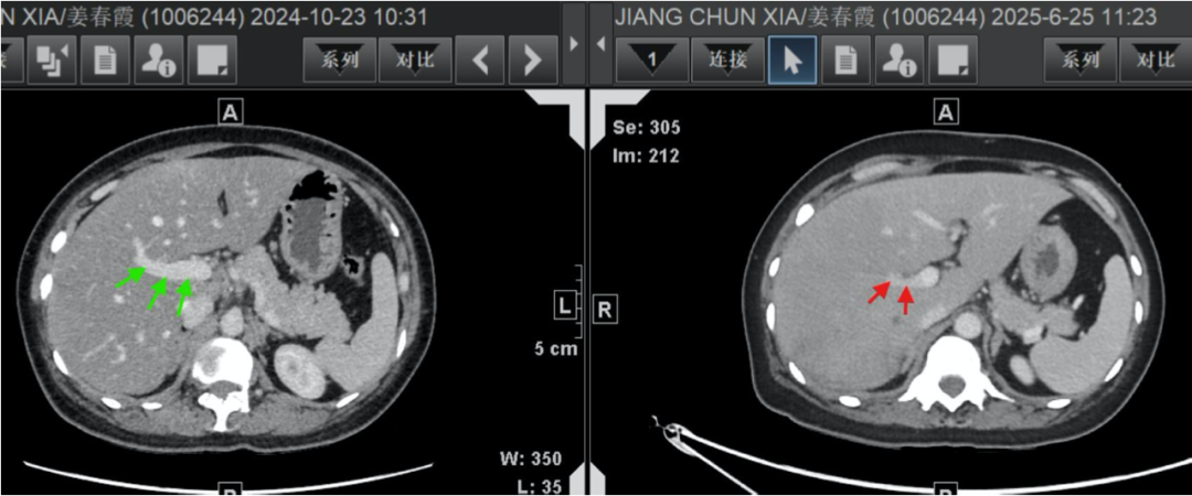 Contrast CT comparison showing portal vein changes before and during treatment