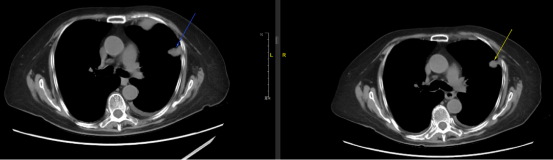CT showing lung metastatic nodule in left upper lobe with arrow indicator
