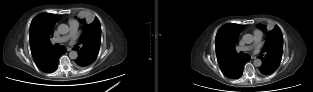 Comparison CT showing lung metastasis shrinkage after radiotherapy