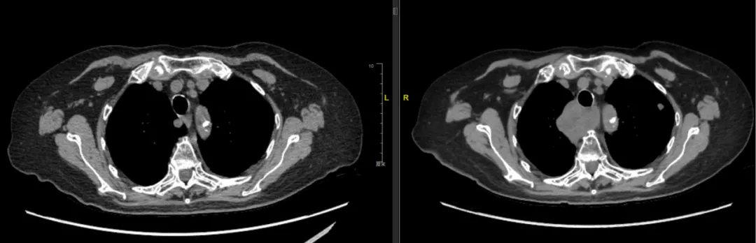 CT comparison of mediastinal lymph nodes before and after first course of radiotherapy