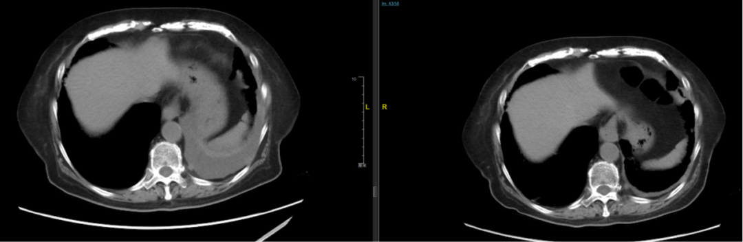 CT of lung bases showing pleural effusion improvement after radiotherapy