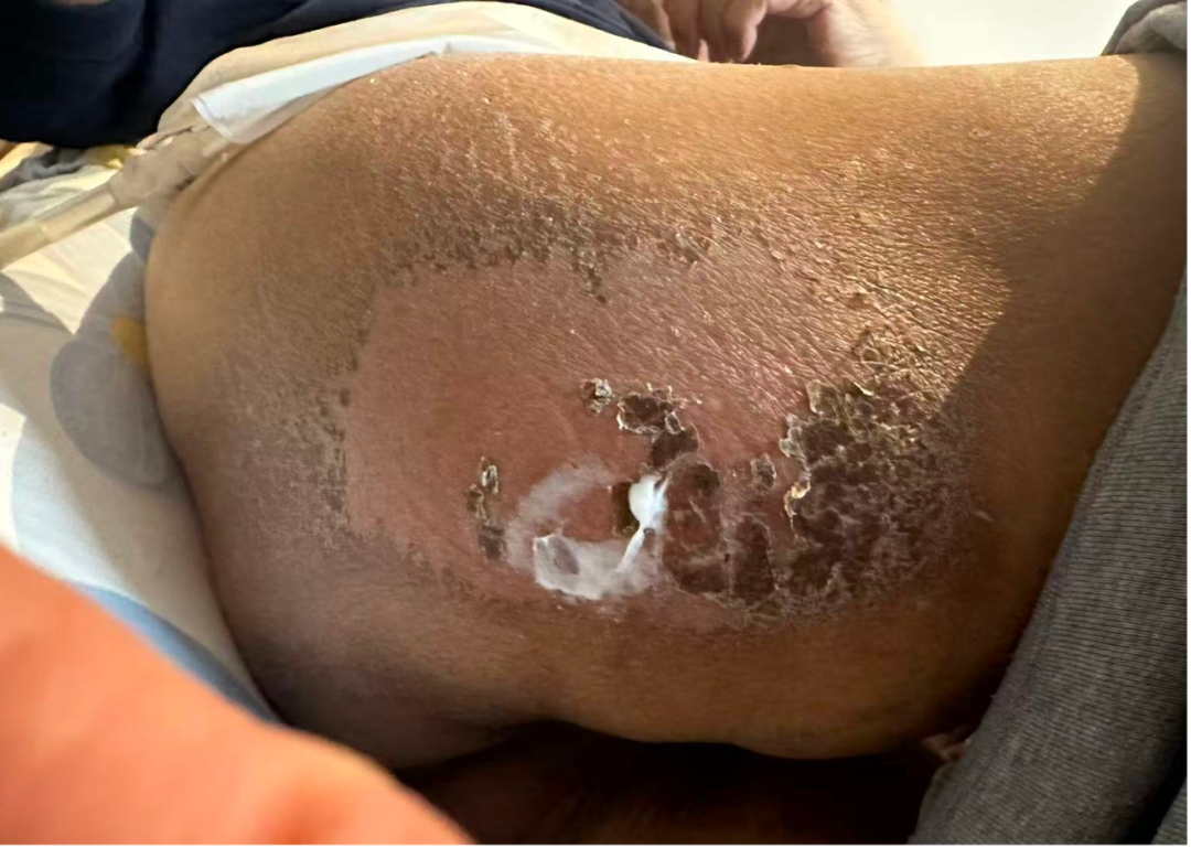 Photograph of right thigh skin showing Grade 1-2 radiation dermatitis with dry desquamation