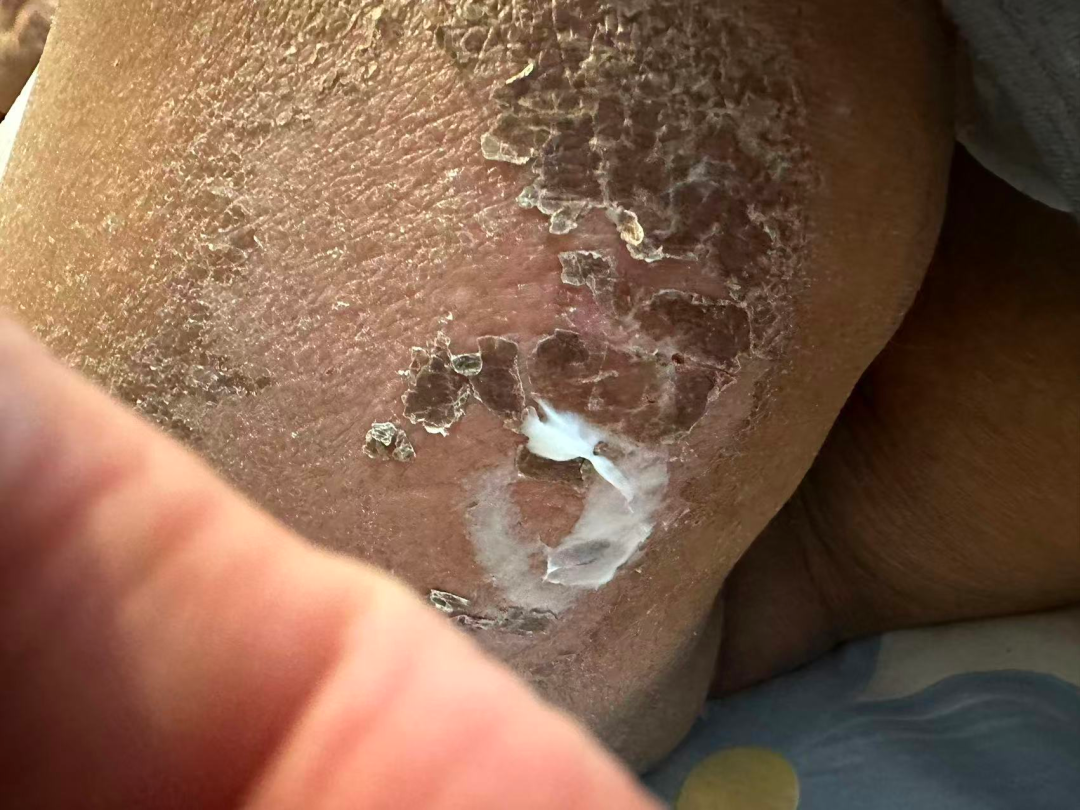 Close-up photograph of healed thigh skin 3 months after radiotherapy