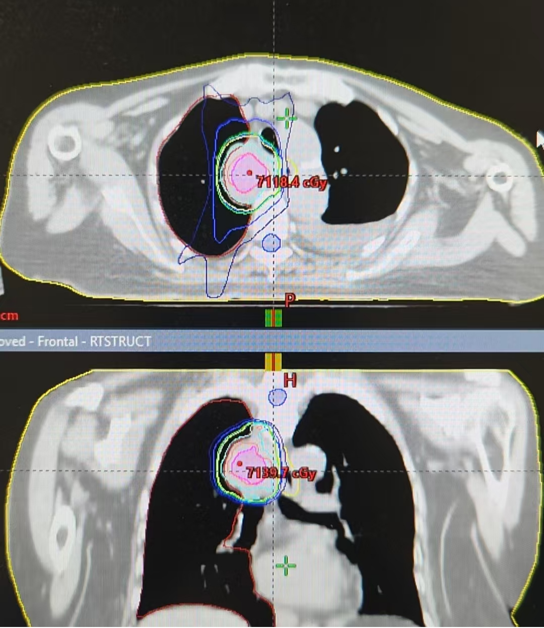 Frontal radiotherapy dose distribution plan showing isodose lines around thigh and chest targets