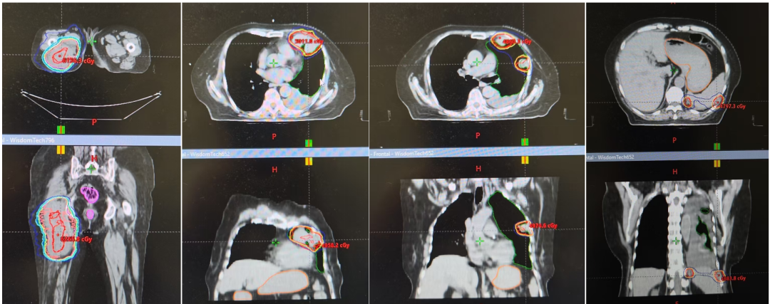 Comprehensive overview of all radiotherapy plans including thigh, chest wall, mediastinal and pleural targets with isodose annotations