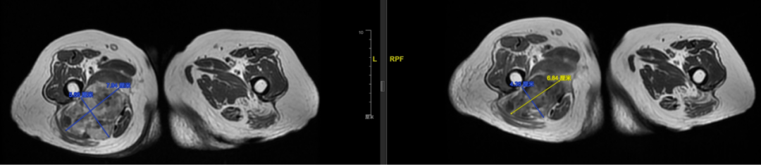 Axial MRI cross-sections of thighs comparing normal left side with tumor-infiltrated right side