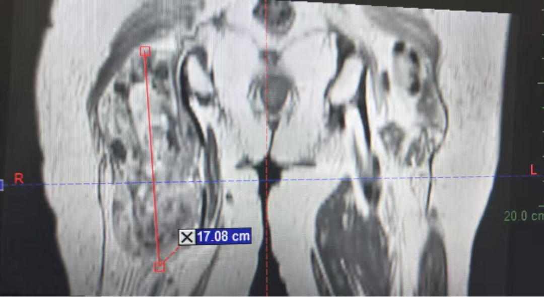 Coronal MRI of pelvis and thighs showing right thigh MPNST measuring 17.08 cm