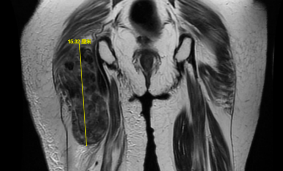 Sagittal MRI of right thigh showing massive recurrent MPNST measuring 15.32 cm in craniocaudal dimension
