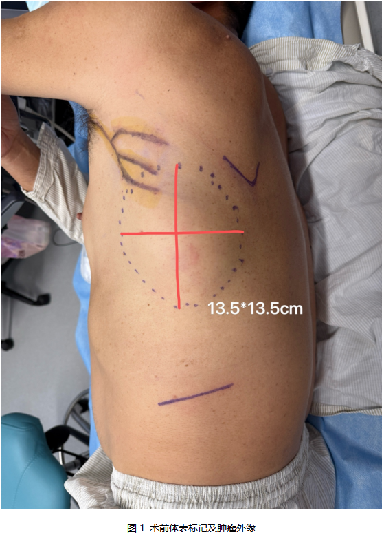 Chest Wall Tumor Crossing Three Ribs: Single-Stage Radical Resection and Reconstruction | Arion — Case Breakthrough Vol. 19