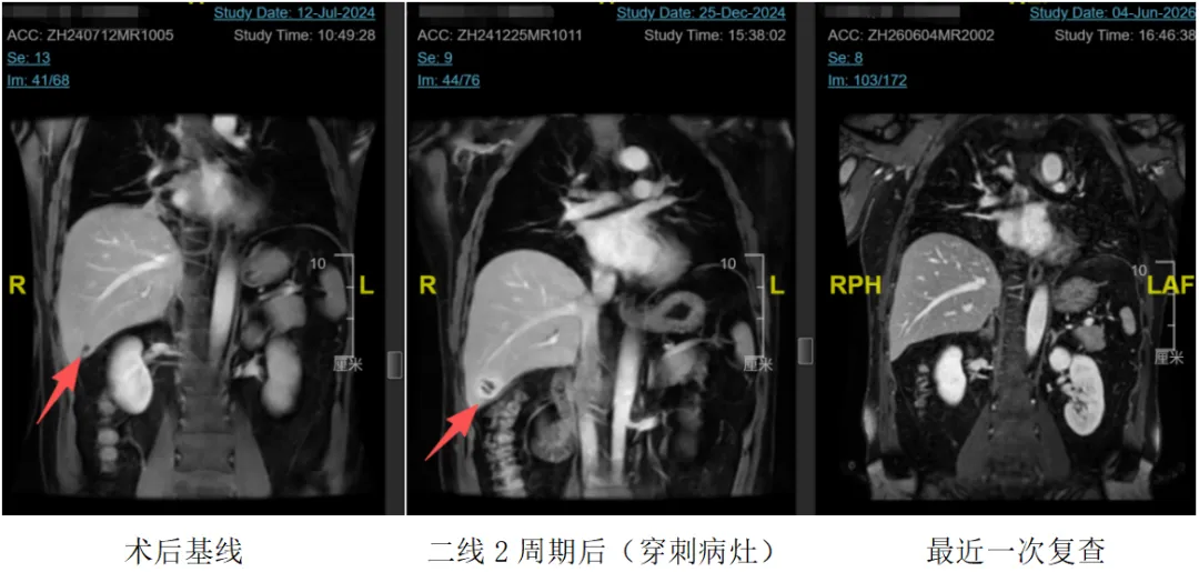 Coronal MRI at postoperative baseline, after two cycles of second-line therapy showing the biopsied lesion, and at the most recent follow-up