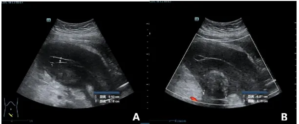 Ultrasound images (panels A and B) showing diffuse uterine enlargement with overall reduced echogenicity and an intact endometrial line, and a 5 cm fibroid in the posterior uterine wall