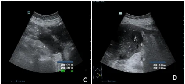 Ultrasound images (panels C and D) showing bilateral adnexal masses with relatively regular morphology, differing from the usual appearance of ovarian epithelial cancer