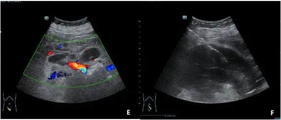 Ultrasound images (panels E and F) showing enlarged lymph nodes around the uterus and the ultrasound-guided uterine biopsy in progress