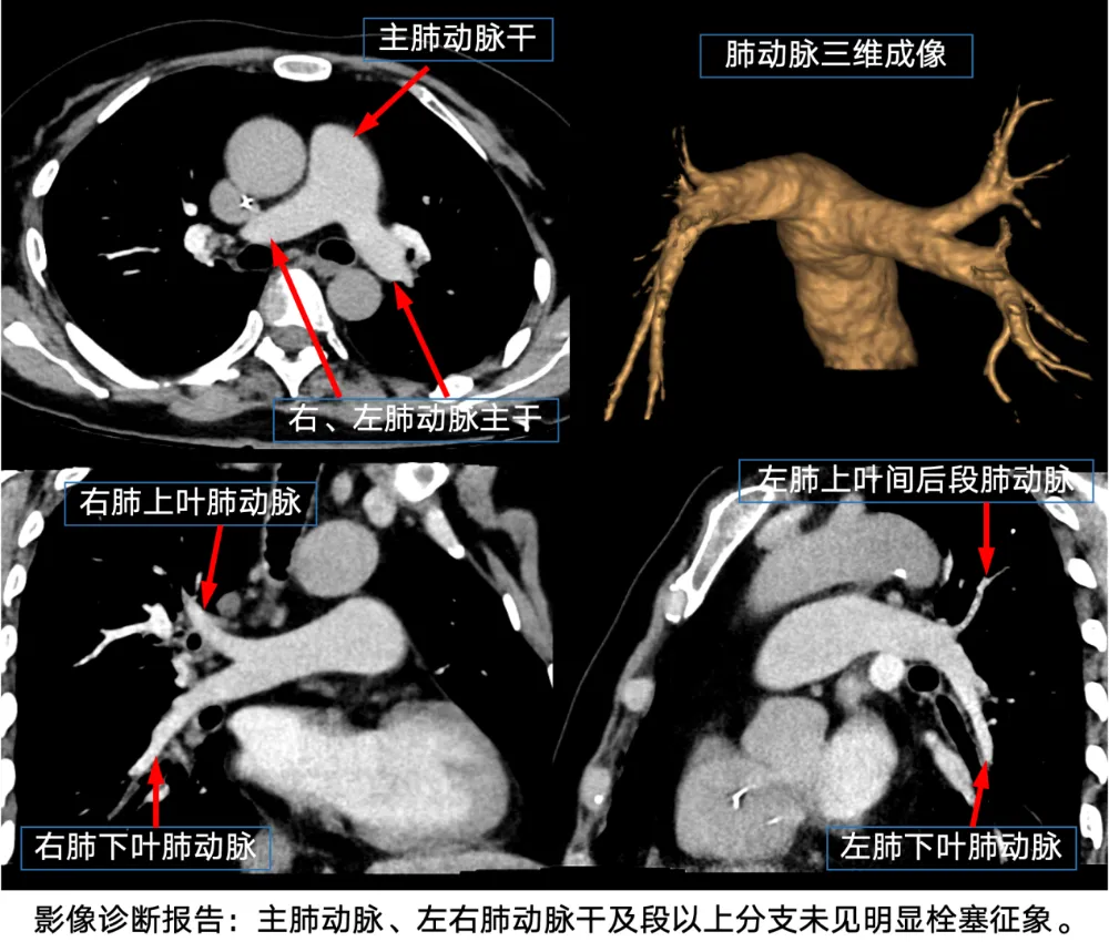 Gadolinium "Dual-Low" CTA with Deep Learning: An MDT Decision for Pulmonary Artery Imaging in an Iodine-Contrast-Allergic Patient | Arion — Case Breakthrough Vol. 25