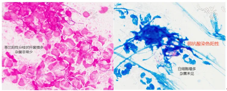 Repeat deep sputum specimen: Gram stain showing a marked increase in Gram-positive branching bacilli and modified acid-fast staining showing weak acid-fast positivity with abundant white blood cells and no commensal organisms