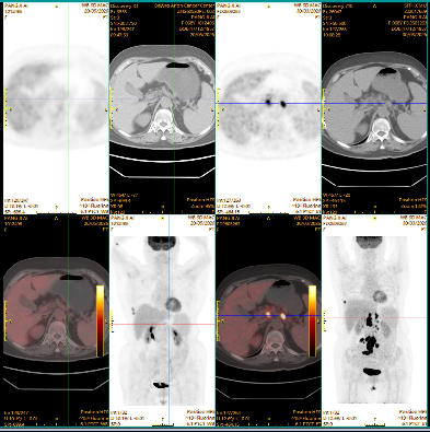 PET-CT after treatment showing disappearance of abnormal uptake in the fused lymph nodes of the hepato-gastric space, mesentery and retroperitoneum, consistent with complete metabolic response