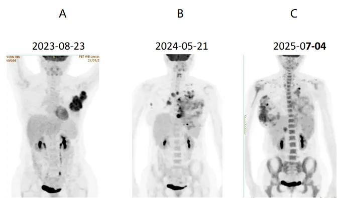 Multi-timepoint 18F-FDG PET-CT whole-body MIP comparison showing the tumour's evolution from local recurrence to widespread systemic metastasis