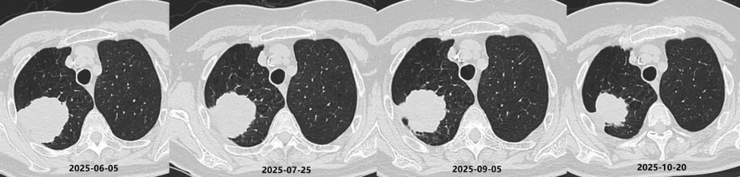 Serial CT scans showing progressive shrinkage of the right upper lung primary tumor from June 2025 to October 2025