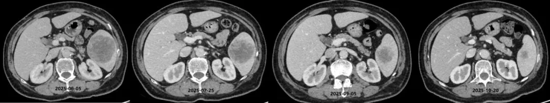 Serial CT scans showing progressive shrinkage of the spleen metastasis from June 2025 to October 2025