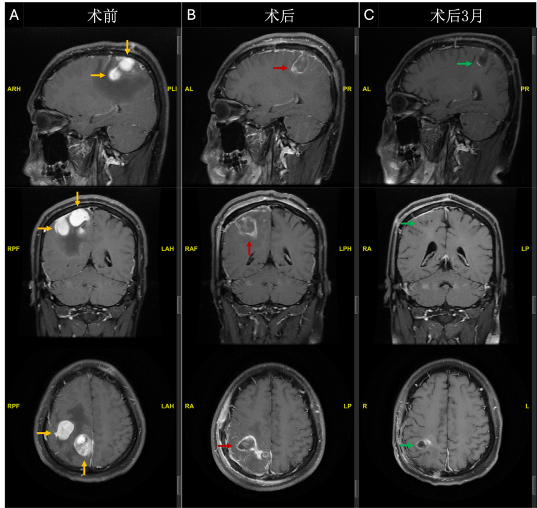 Serial brain MRI timeline: preoperative with multiple right parietal tumors (yellow arrows), 1-week postoperative with cavity enhancement (red arrows), and 3-month follow-up with reduced enhancement and edema (green arrows)