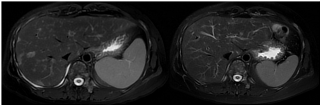 Follow-up abdominal MRI (January 2026) showing marked reduction in liver metastases after Capivasertib + Fulvestrant therapy, assessed as partial response