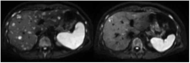 Baseline abdominal MRI (August 2025) showing multiple liver metastases in T2-weighted and DWI sequences before Capivasertib treatment