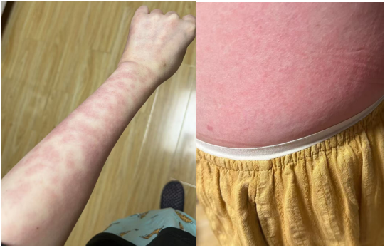 Grade 3 drug-induced maculopapular rash on patient's arm and abdomen covering >30% BSA, characteristic of AKT inhibitor skin toxicity