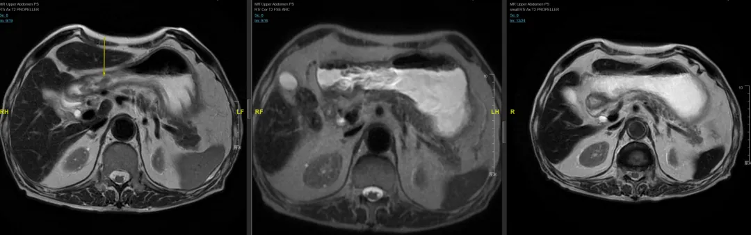 Follow-up gastric MRI T2 non-fat-suppressed sequences at pre-treatment, 6 months post-RT, and 10 months post-RT