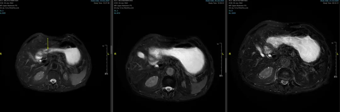 Follow-up gastric MRI T2 fat-suppressed sequences at pre-treatment, 6 months post-RT, and 10 months post-RT showing progressive tumor shrinkage