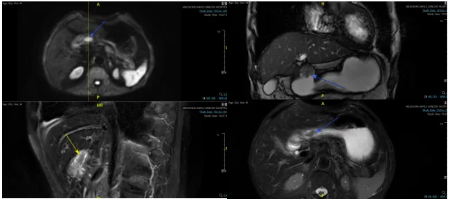 Pre-treatment gastric MRI (T2 fat-suppressed) showing 4x4cm elevated tumor in gastric antrum with full-thickness wall invasion