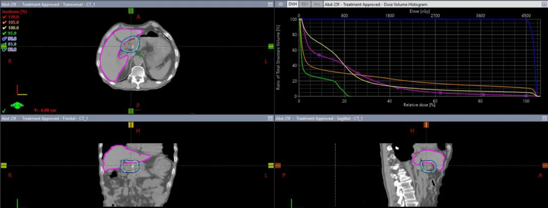 IMRT radiation treatment plan for gastric antrum tumor showing dose distribution with 45Gy in 25 fractions, with kidney and small bowel dose constraints