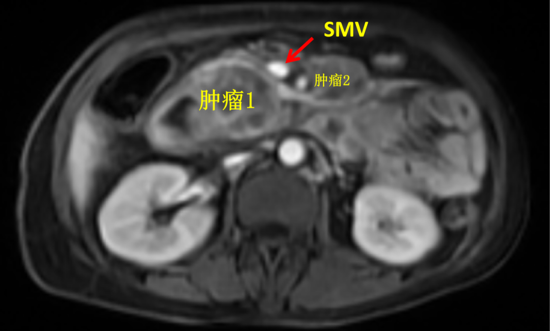 Postoperative follow-up imaging showing successful R0 resection status after radical pancreaticoduodenectomy with no evidence of residual tumor
