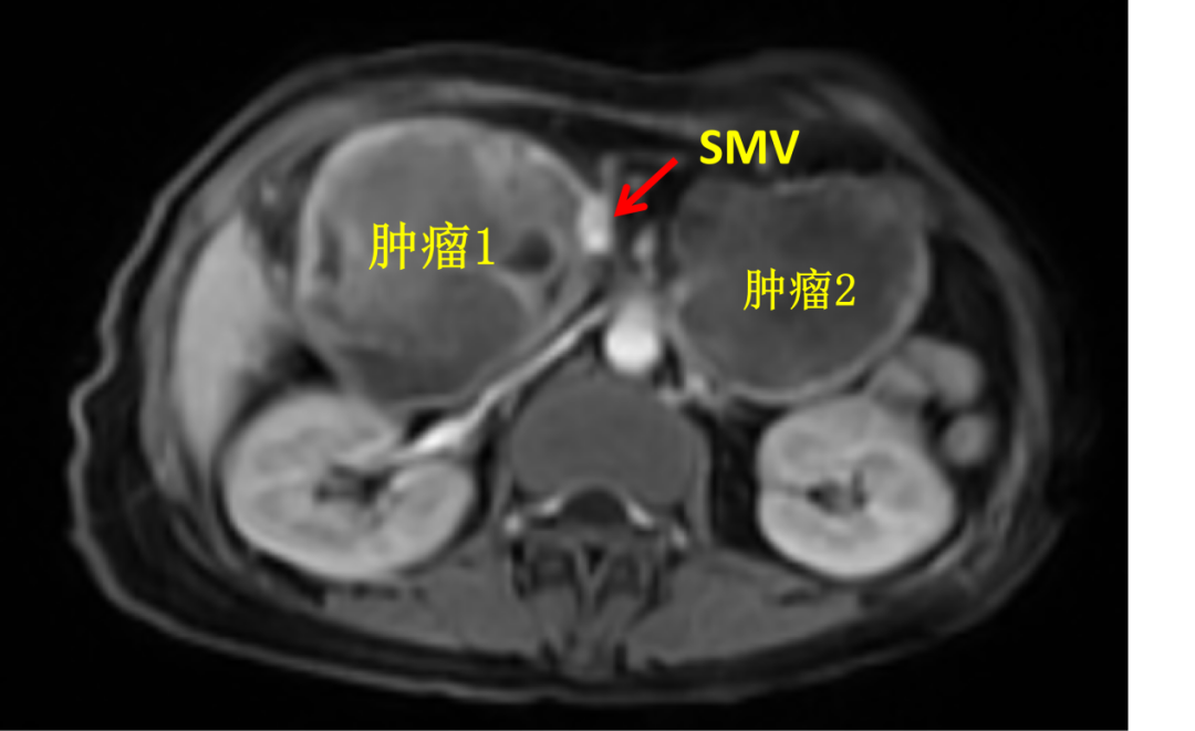 Preoperative abdominal MRI showing two large duodenal tumors (Tumor 1 and Tumor 2) with intimate relationship to the superior mesenteric vein (SMV)